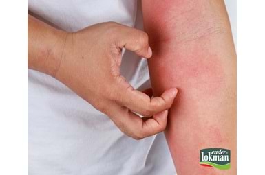 Uyuz Hastalığı ve Belirtileri Nelerdir?